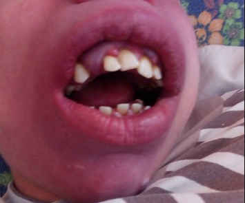 рот пациента с  синдромом штурге вебера
